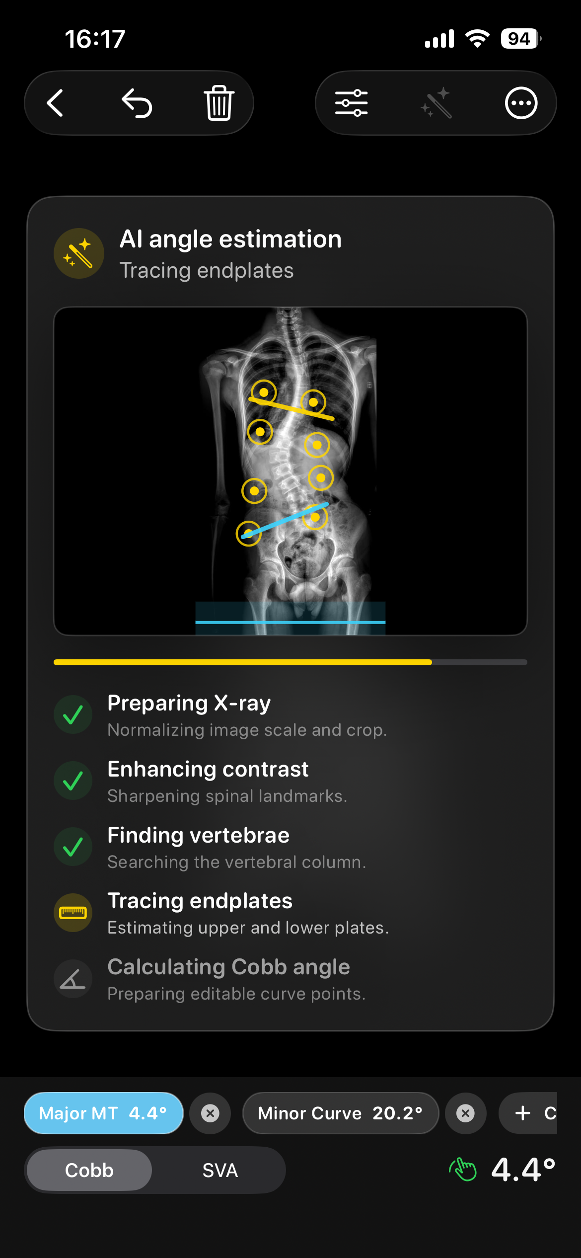 Cobb Angle Pro dark mode assisted angle candidate tracing